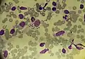 Extracellular and intracellular (macrophages) leishmania parasites in a patient with cutaneous leishmaniasis (May-Grünwald Giemsa x1000).